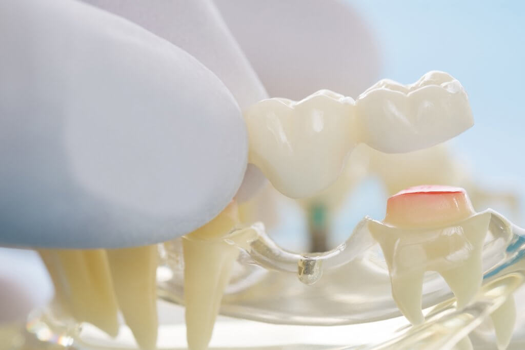 how-long-do-dental-bridges-last